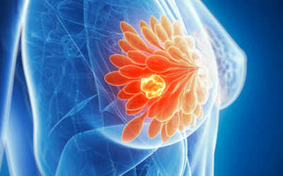 CLIPPING THE POSITIVE LYMPH NODE WITH CLINICALLY NODE POSITIVE BREAST CANCER TREATED WITH NEOADJUVANT CHEMOTHERAPY: IMPACT OF AXILLARY SURGERY IN THE ISPY-2 CLINICAL TRIAL